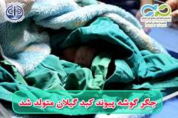تولد نوزادی از پیوند کبد در گیلان؛ نمادی از بخشش و امید